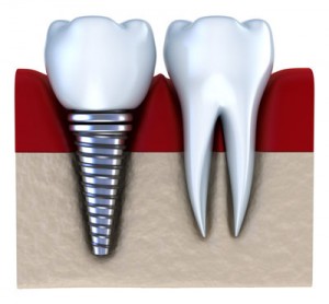 Dental Implants