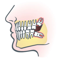 wisdom-teeth-north-texas